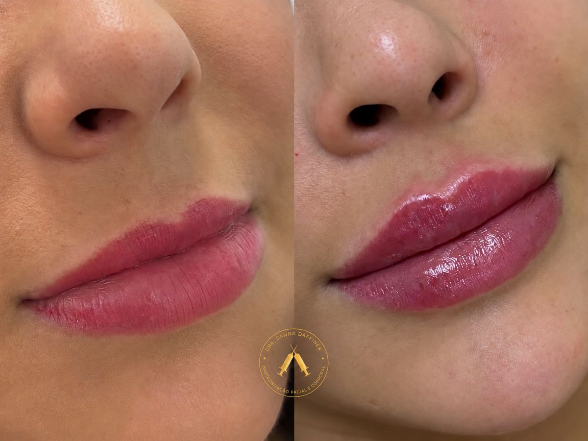 Antes e depois de preenchimento labial